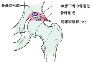 股関節について[人工股関節置換術[THA,THR]｜田辺中央病院(和歌山)