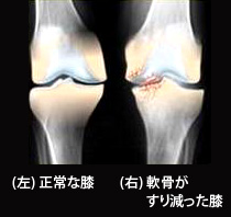 正常な膝と軟骨がすり減った膝
