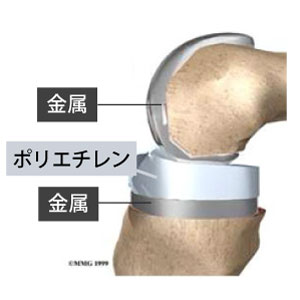人工膝関節②